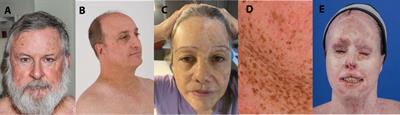 Retrospective study of efficacy and adverse events of immune checkpoint inhibitors in 22 xeroderma pigmentosum patients with metastatic or unresectable cancers